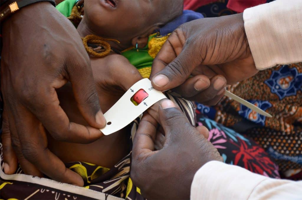 Close-up of the arm of a severely malnourished child being measured by a healthcare worker.